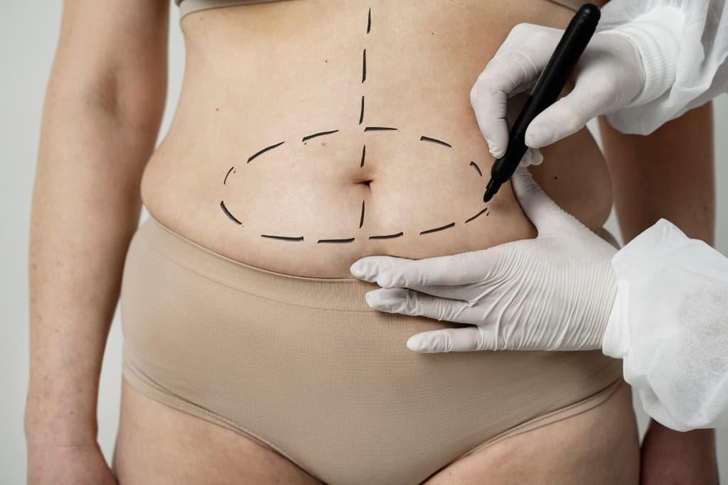 Abdominoplastia en Clínica Londres
