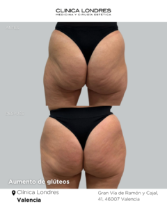 antes y después de aumento de glúteos con ácido hialurónico