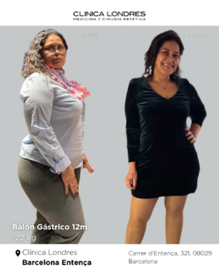 imagen de antes y después de una paciente con balón gástrico 12 meses