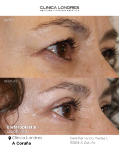 Imagen de resultado cirugia blefaroplastia