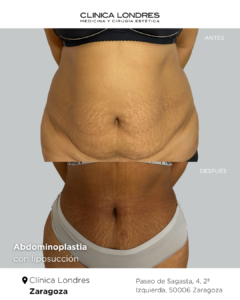 antes y después de abdominoplastia