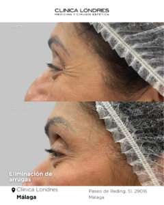 tratamiento eliminación de arrugas