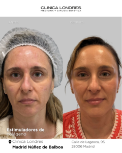 tratamiento de estimulación de colágeno
